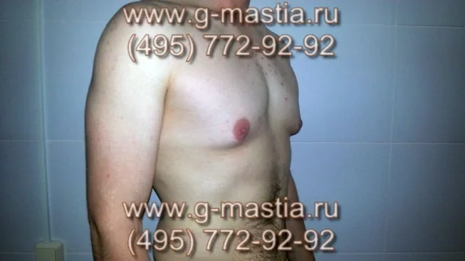 Гинекомастия - железы под сосками