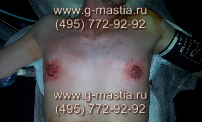 Операция по удалению гинекомастии завершена. Выполнена подтяжка кожи - параареолярная пексия