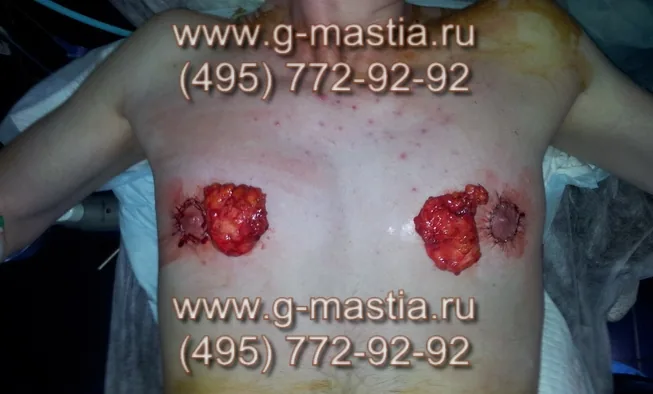 Удаленные железы при гинекомастии