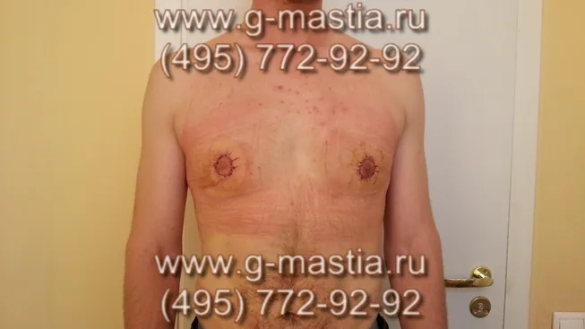 Пациент через день после операции на перевязке