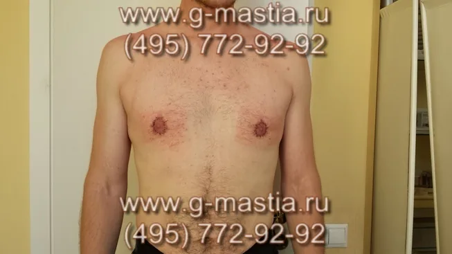 Пациент на осмотре через 13 дней