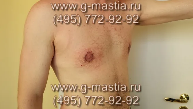 Пациент очень доволен результатом операции при гинекомастии