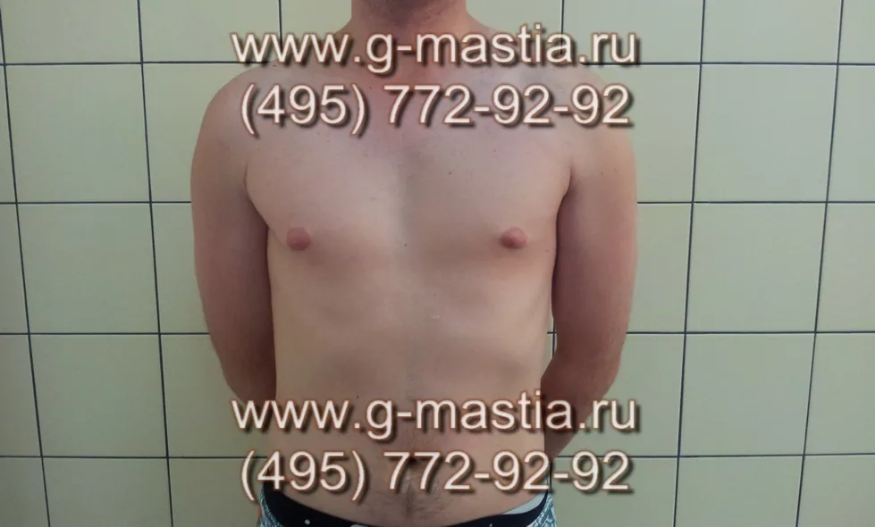 Операция при истинной гинекомастии.