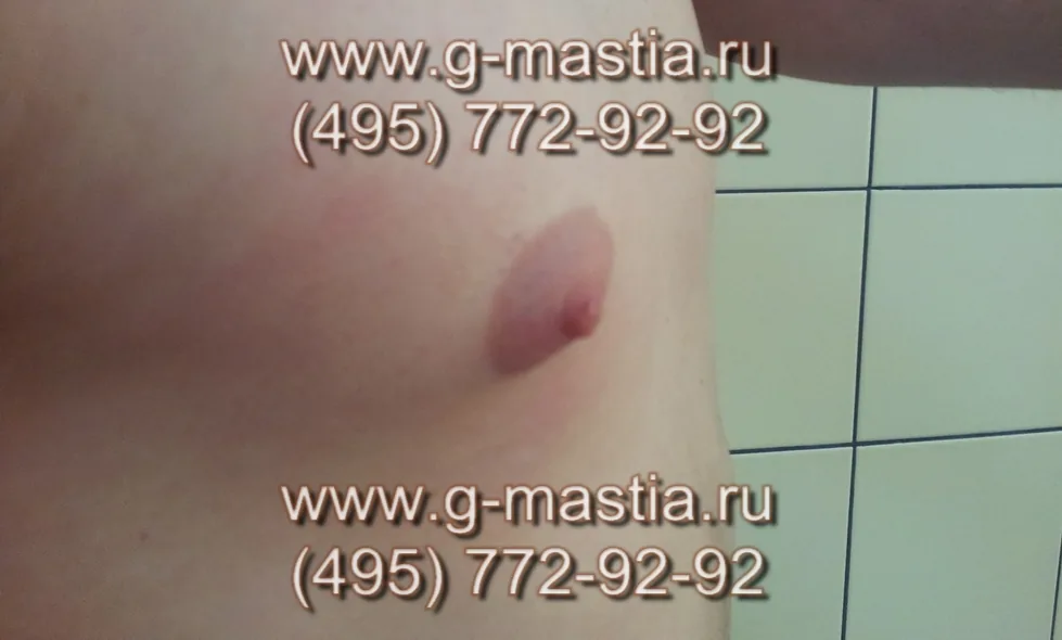 Истинная гинекомастия, железы расположены под сосками