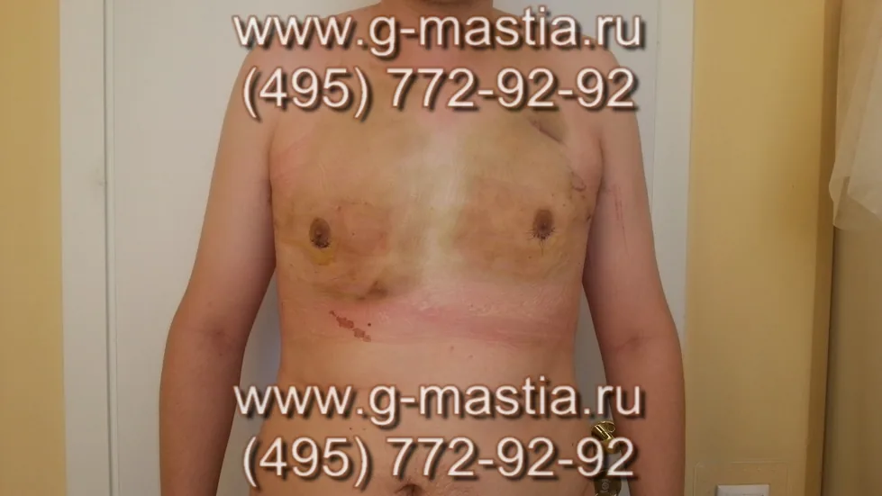 Пациент на следующий день после операции