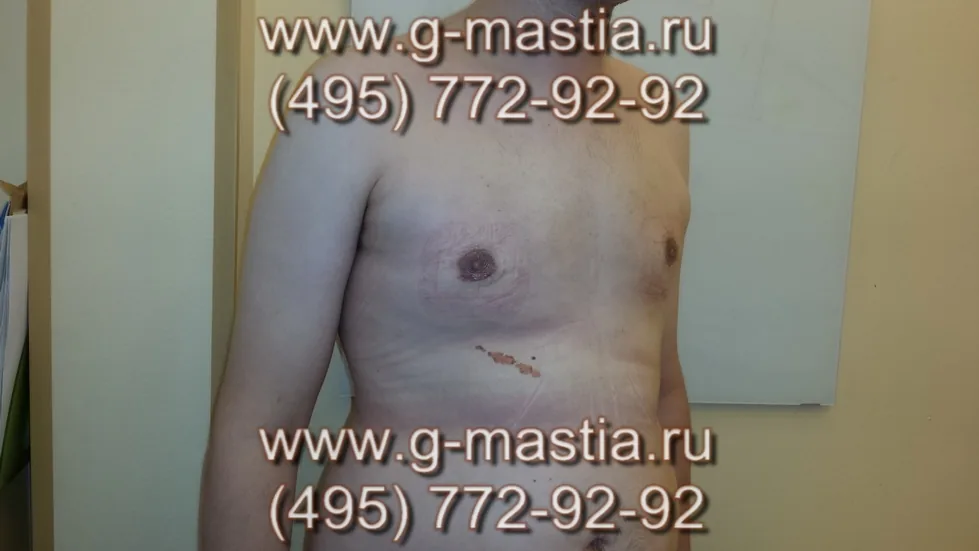 Пациент через 3 недели после операции