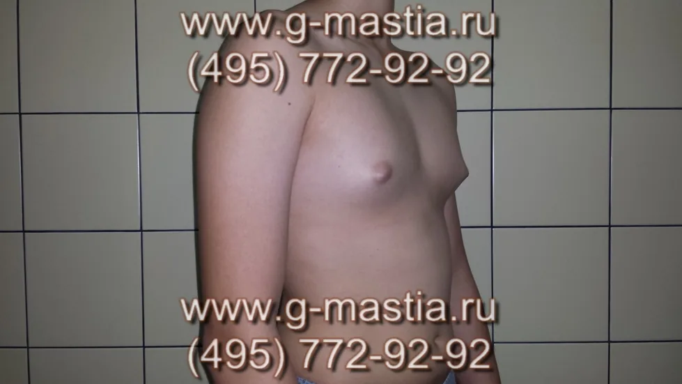 У пациента смешанная форма гинекомастии