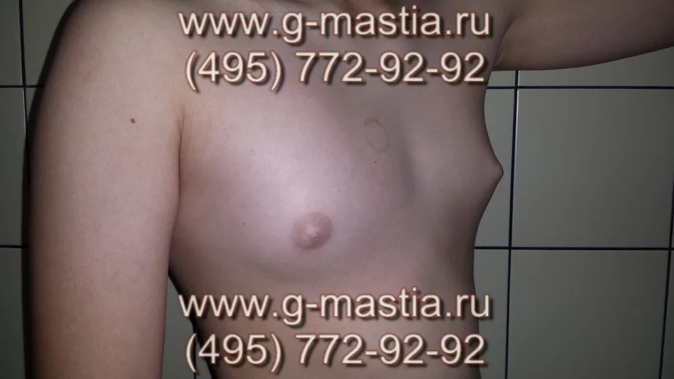 Увеличенная грудь