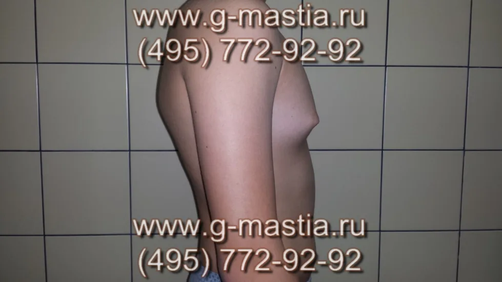 Пациент, чтобы скрыть увеличенную грудь, начал сутулиться, из-за чего сформировался сколиоз первой степени