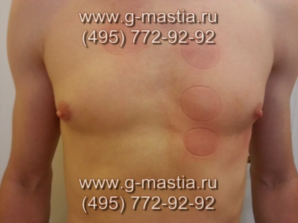 Операция при истинной гинекомастии.