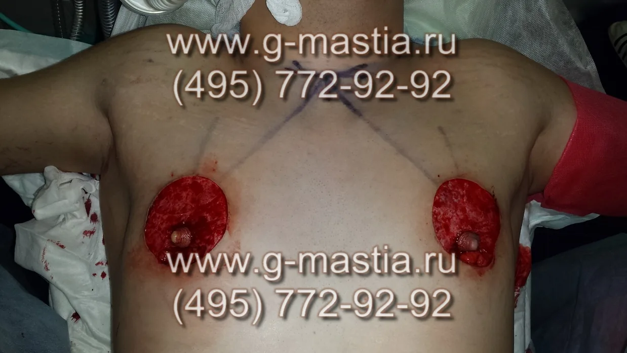 Выполнена деэпидермизация излишка кожи