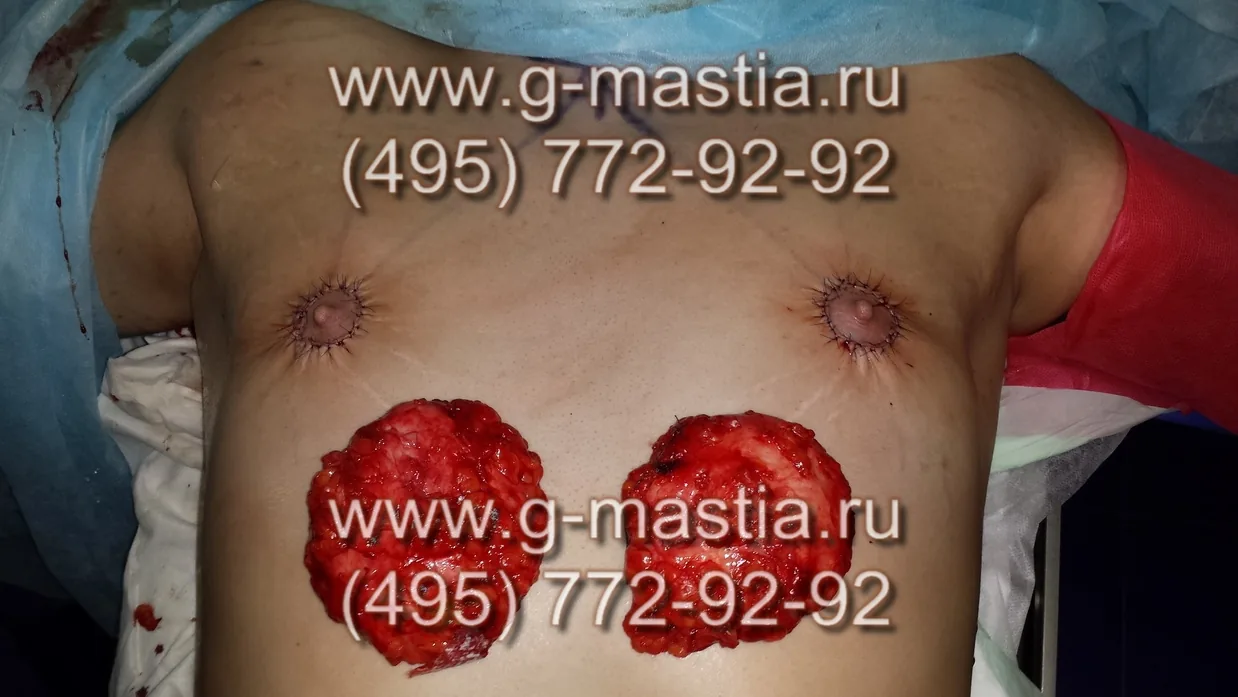 Удалённые железы очень больших размеров