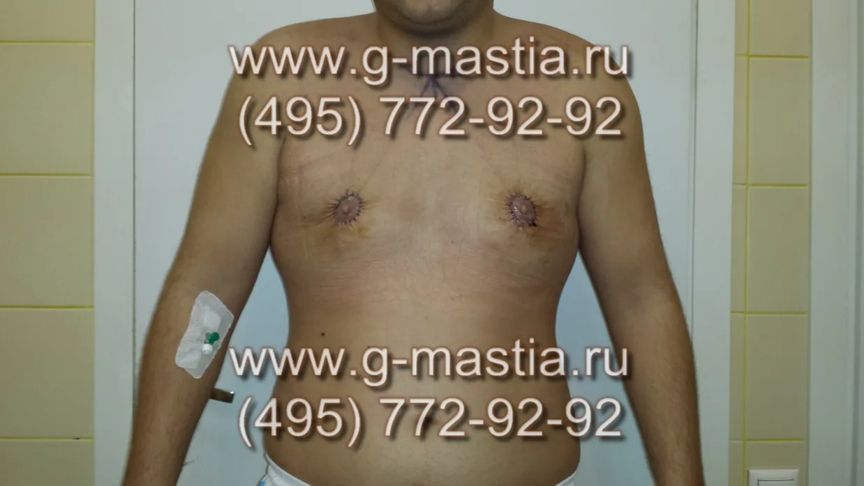 Пациент на следующий день после операции