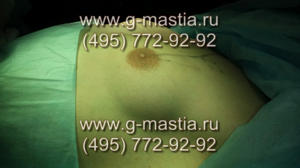 Пациент на операционном столе, женоподобная грудь