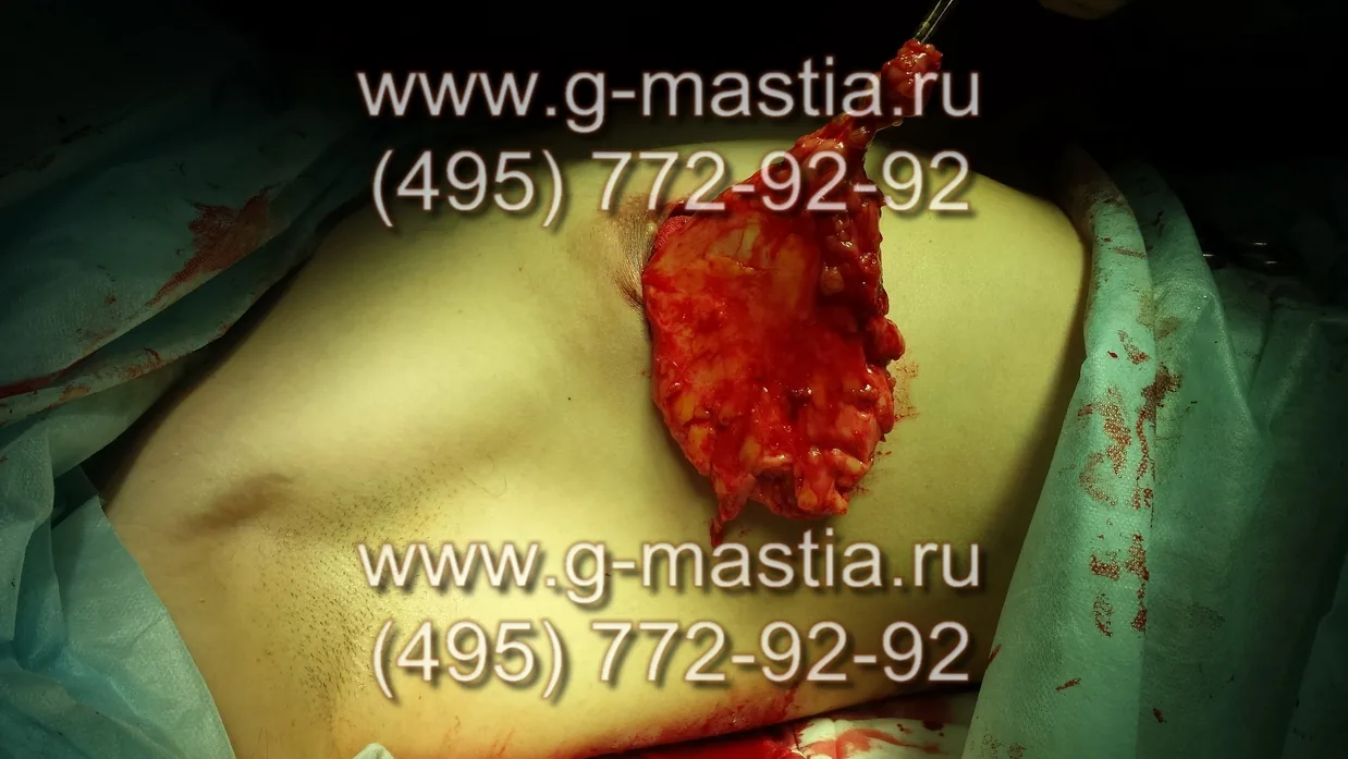 Удаление железы