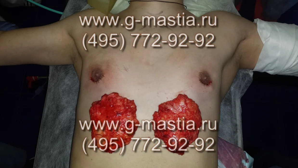 Удалённые железы очень больших размеров