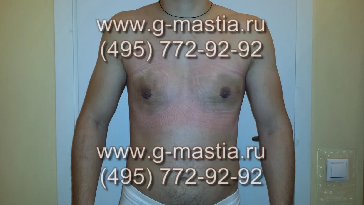 Пациент на перевязке на следующий день