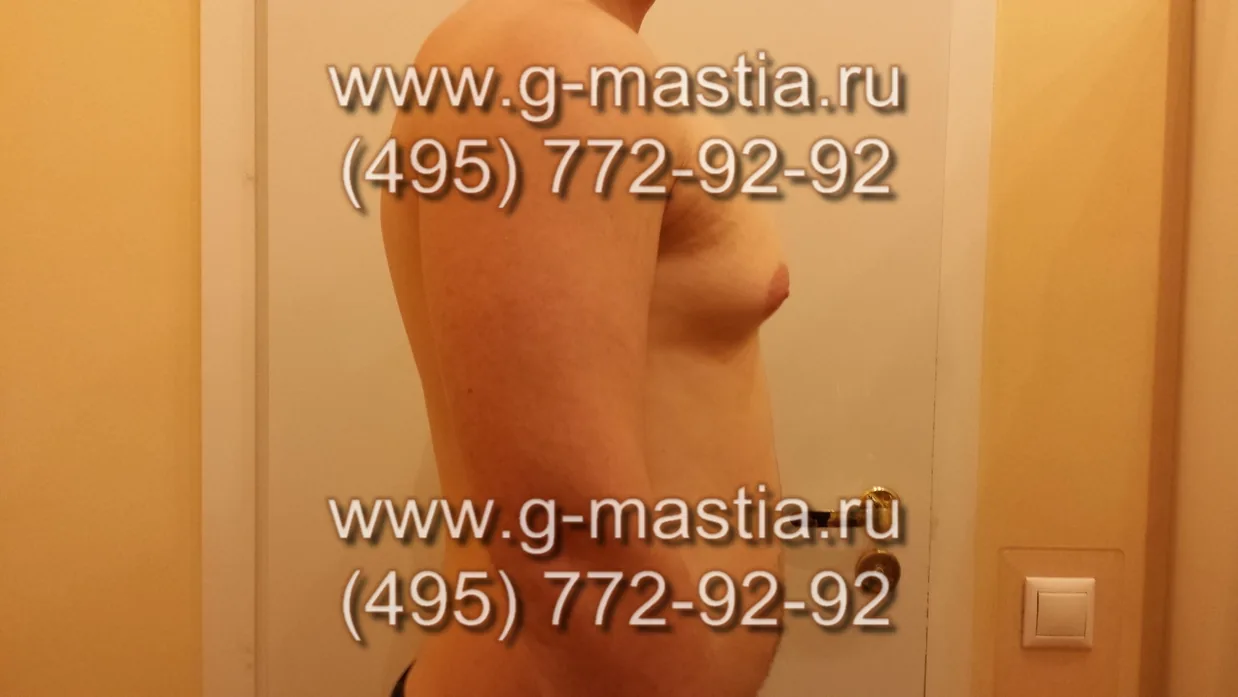 Смешанная форма гинекомастии
