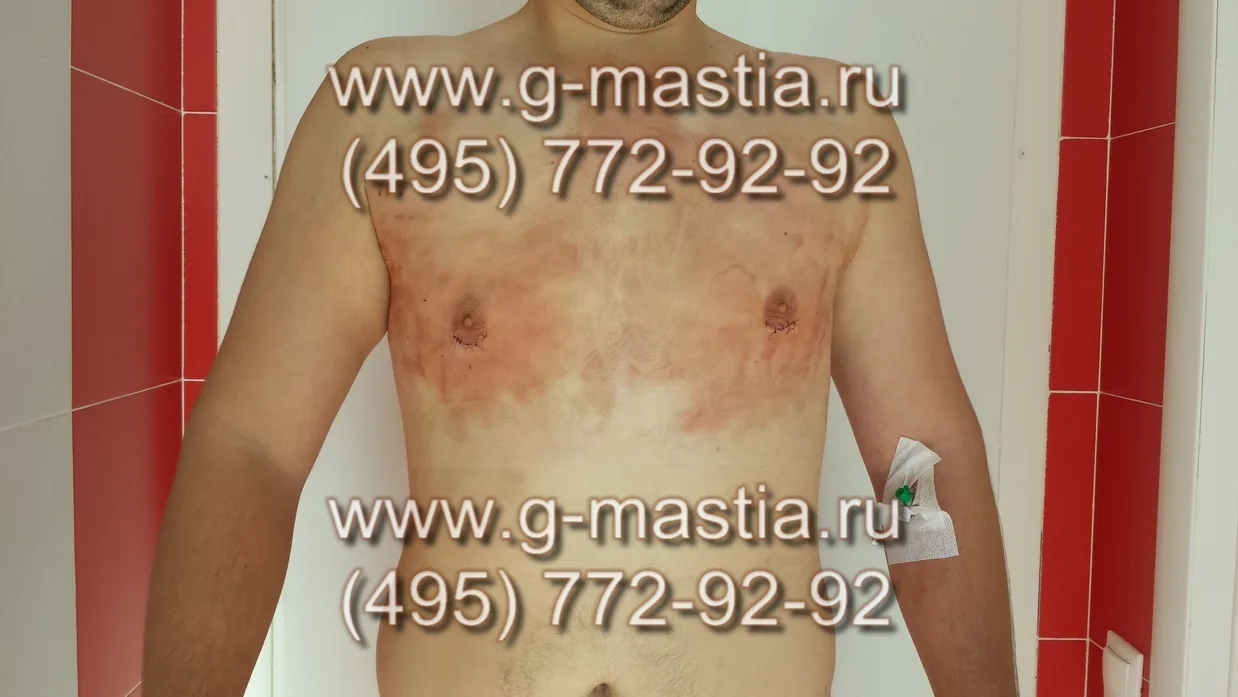 На следующий день на перевязке