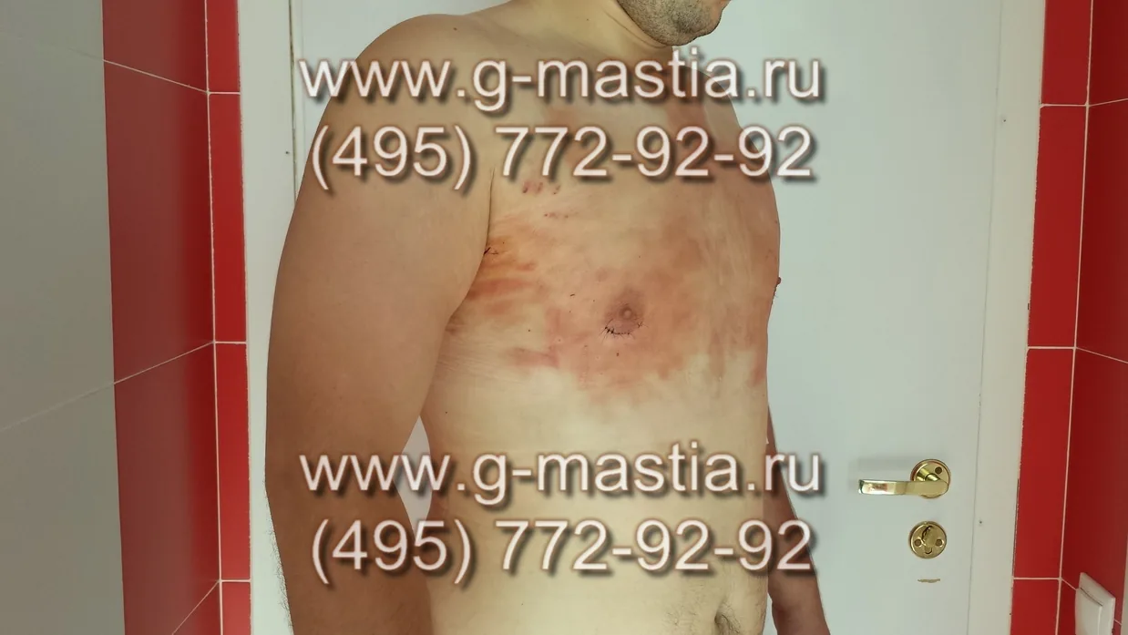 Синяки и гематомы - нормальное явление после липосакции