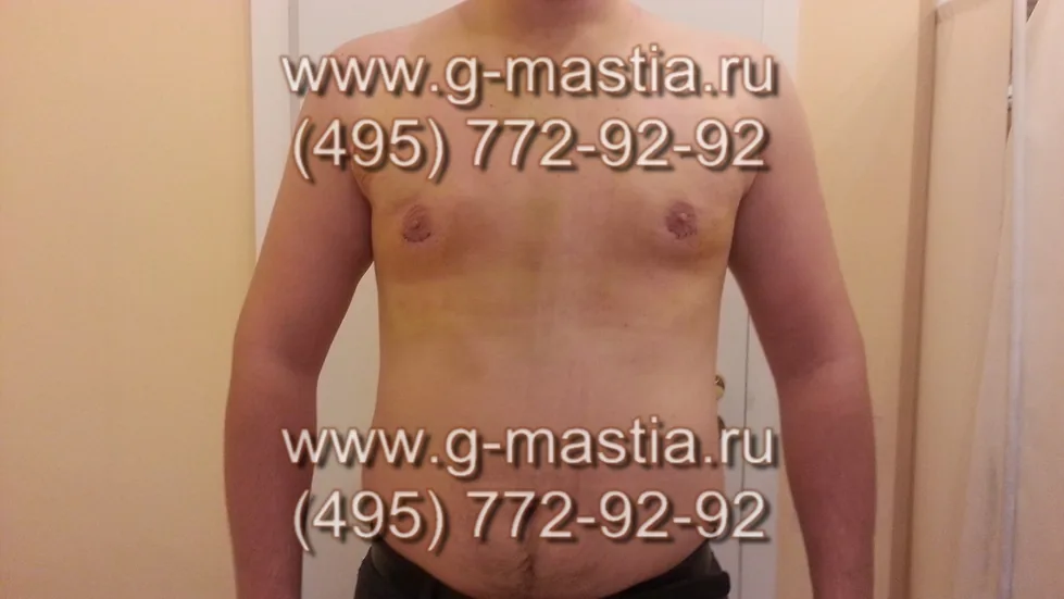 Результат удаления гинекомастии через 5 дней