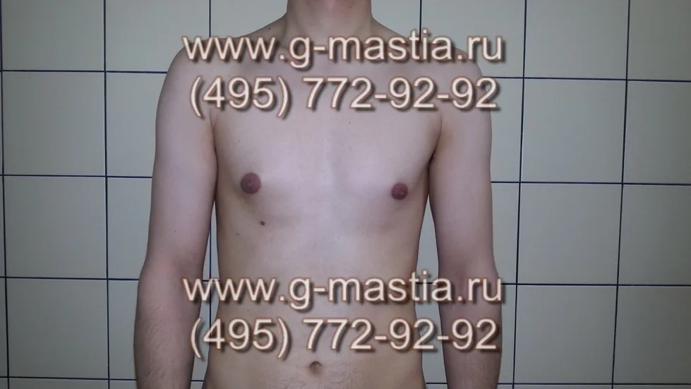 Удаление двухсторонней гинекомастии истинной формы