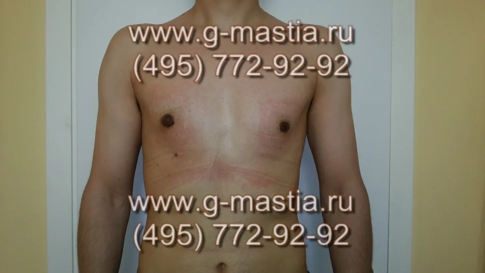 Пациент через 14 дней на снятии швов
