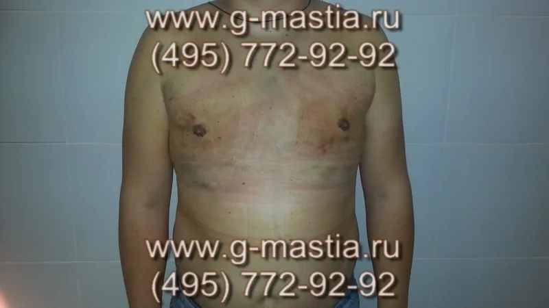 Пациент на следующий день после операции. Отёчность и гематомы - норма после липосакции