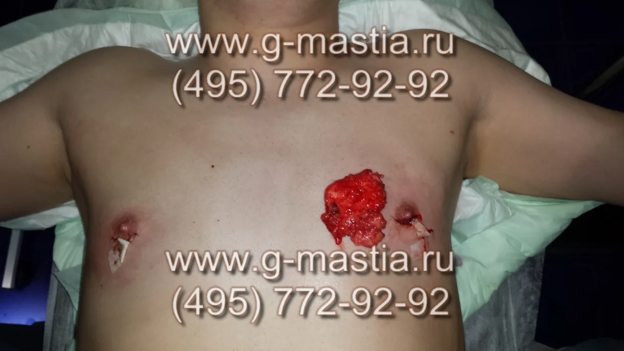 Операция завершена. Удаленная железа слева