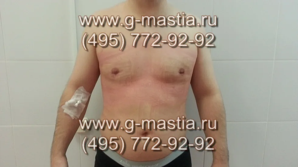 Перевязка на следующий день