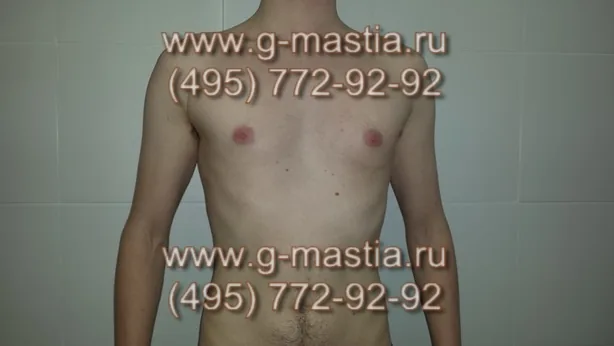 Истинная гинекомастия. Вид рубцов через 2 недели после операции