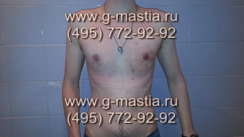 Пациент на следующий день после операции