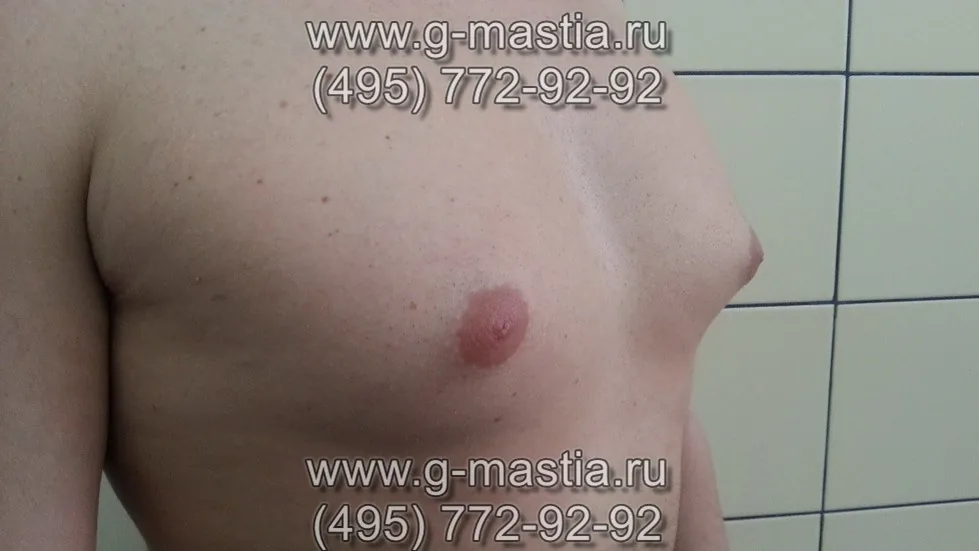 Липомастия