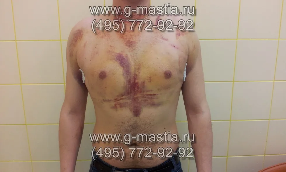Пациент через 8 дней после операции