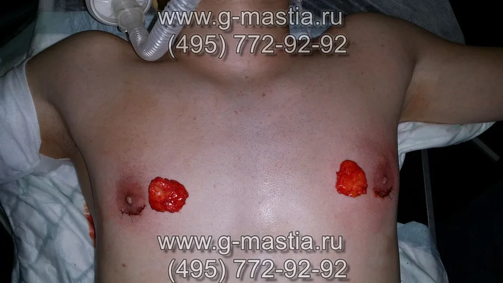 Удалённые железы