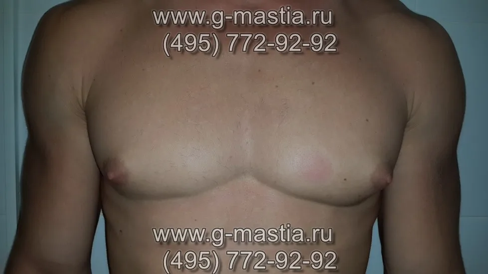 Истинная форма гинекомастии
