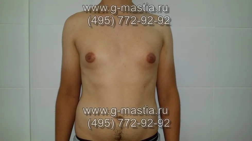 Истинная гинекомастия. Коррекция формы ареол сосков.