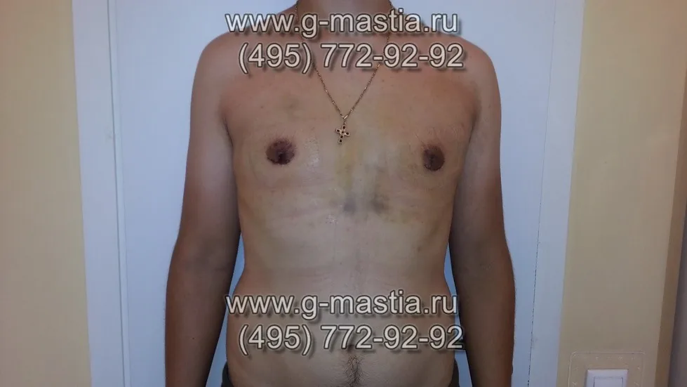 Пациент через 10 дней на снятии швов