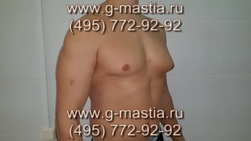 Пациент до операции. Гинекомастия асимметричной формы