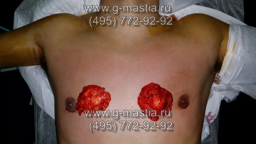 Удалённые железы достаточно больших размеров