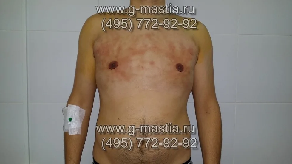 Пациент на перевязке на следующий день после операции