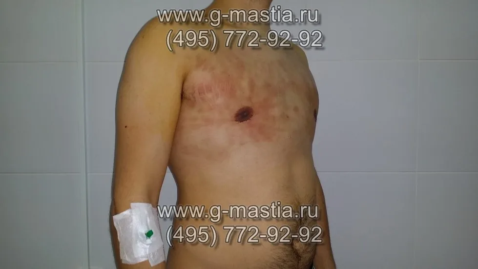Пациент на перевязке