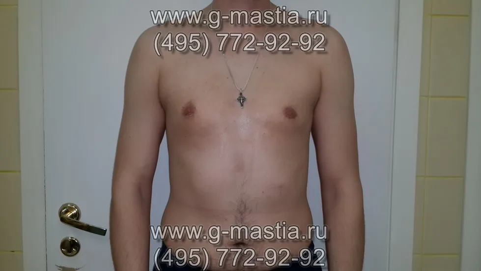 Пациент через 20 дней после операции