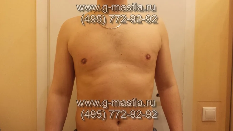 Пациент через 21 день после операции