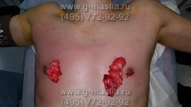 Удалённые грудные железы