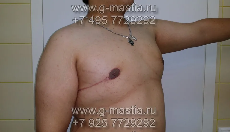 Результат операции удаления большой гинекомастии