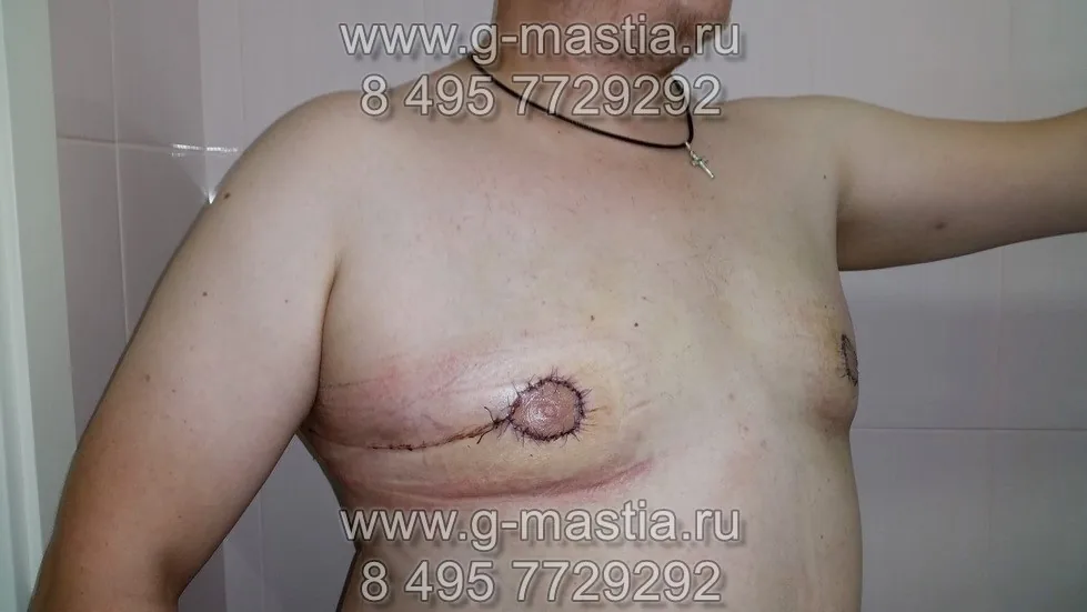 После операции удаления гинекомастии. На следующий день