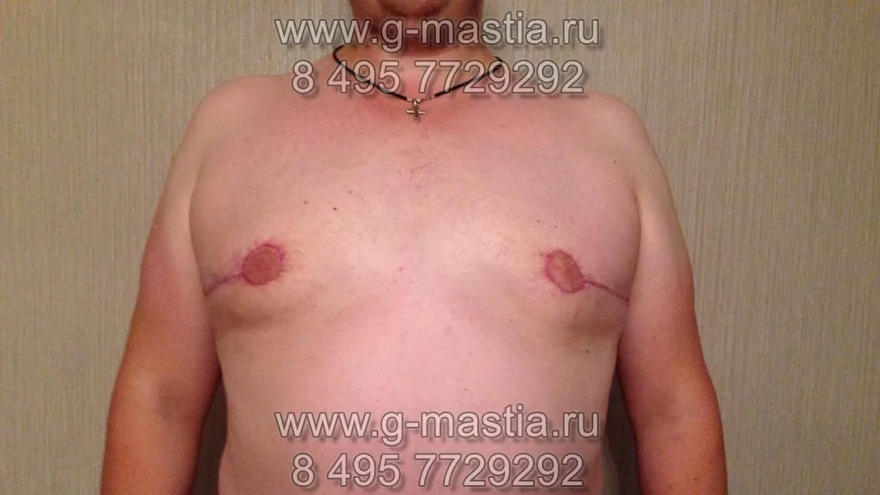Подтяжка груди у мужчины со смешанной формой гинекомастии большого размера. Через месяц
