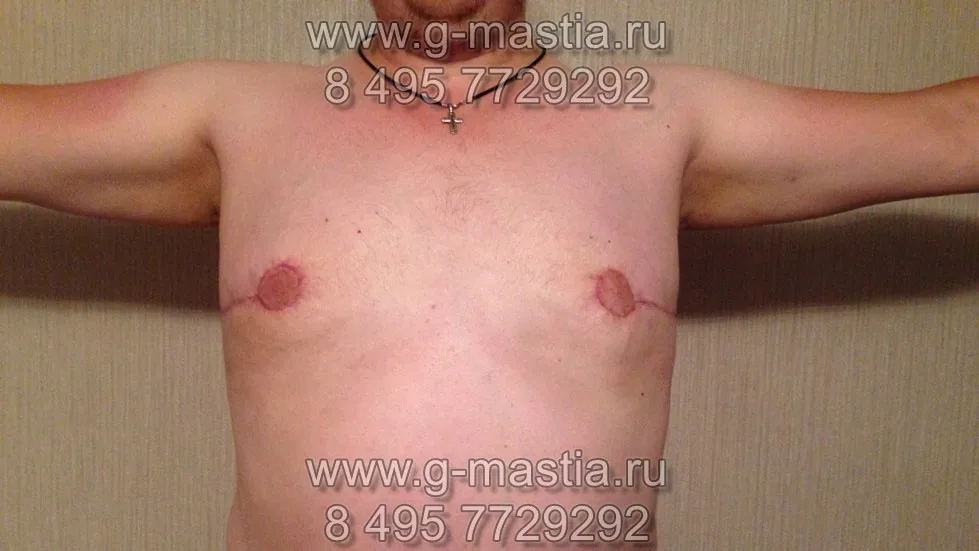 После операции удаления гинекомастии. Через месяц