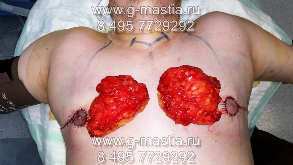 Удалённые грудные железы